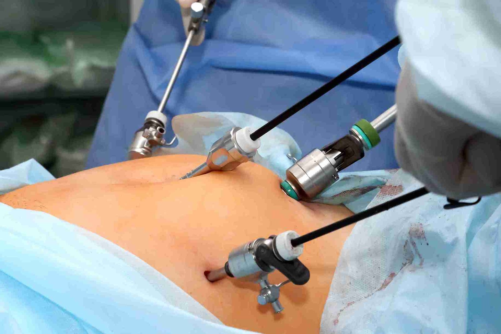 Laparoscopic & Cosmetic Gynaecology at Sarvagya Healthcare